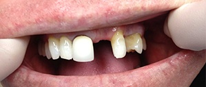 Patient 2 smile with missing front tooth before
