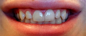 Patient 3 bright white smile after cosmetic dentistry