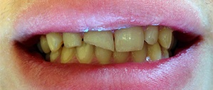Patient 3 yellowed smile before cosmetic dentistry
