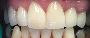 Patient 5 with healthy white teeth after treatment