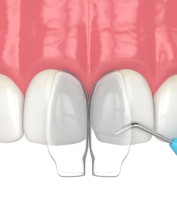 Illustration of dental bonding in Mansfield, TX