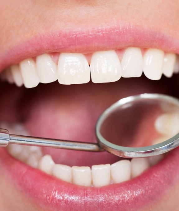 Closeup of an open mouth with dental mirror looking at upper teeth