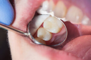 Tooth-colored filling visible in dental mirror